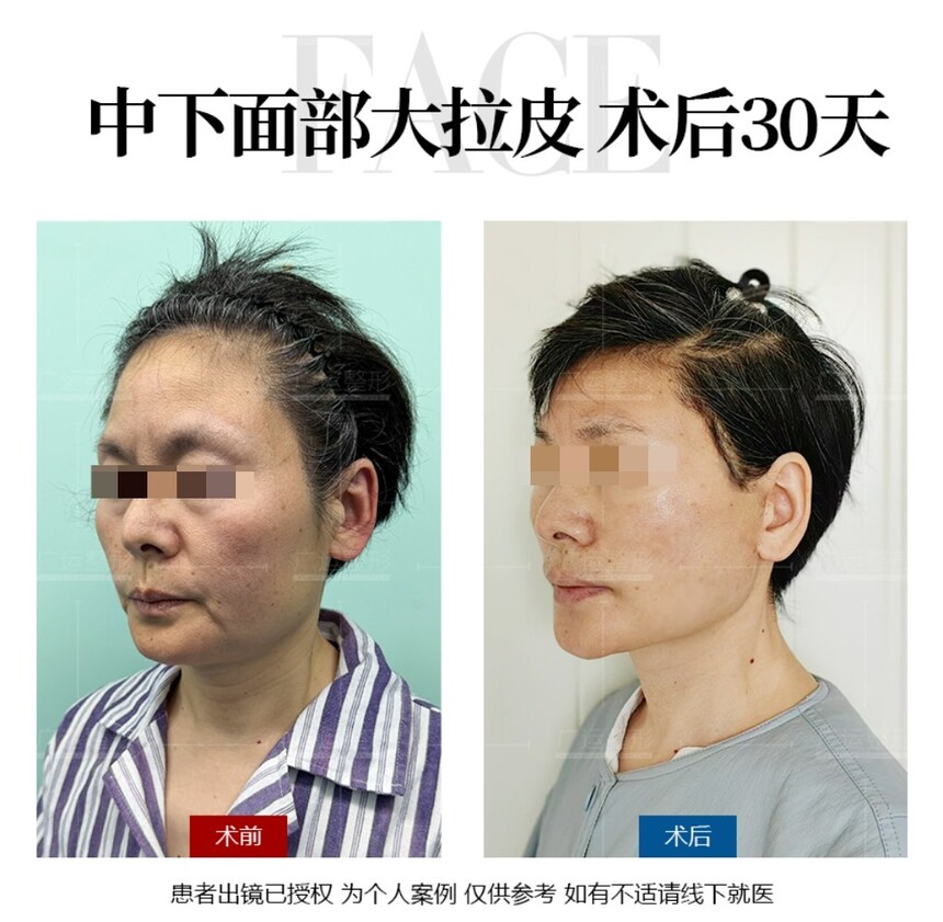 魏广运面部拉皮案例.jpg 魏广运面部拉皮案例.jpg