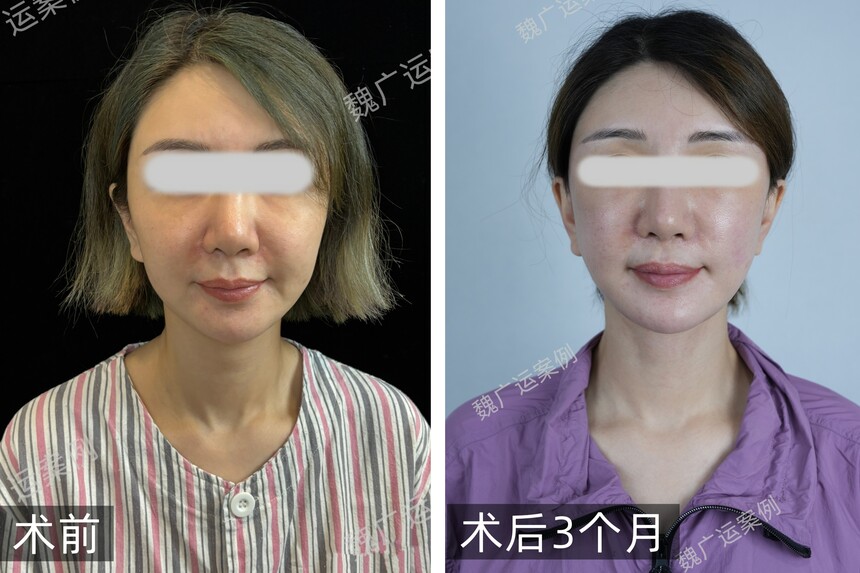 魏广运拉皮案例 魏广运拉皮案例