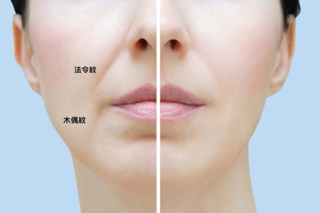 法令纹 法令纹