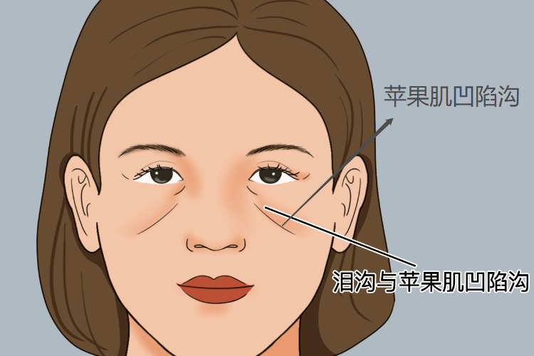 苹果肌凹陷 苹果肌凹陷