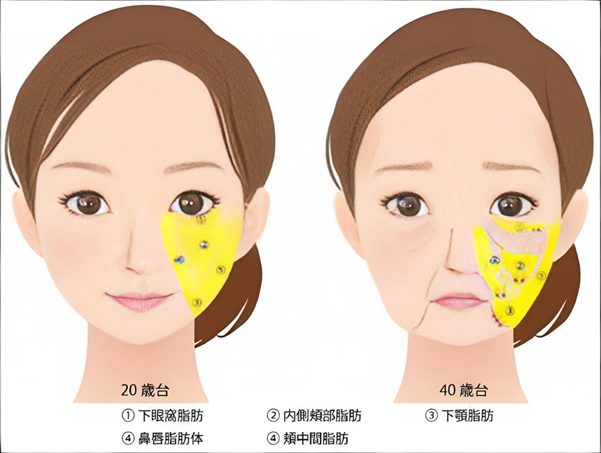 苹果肌提升 苹果肌提升