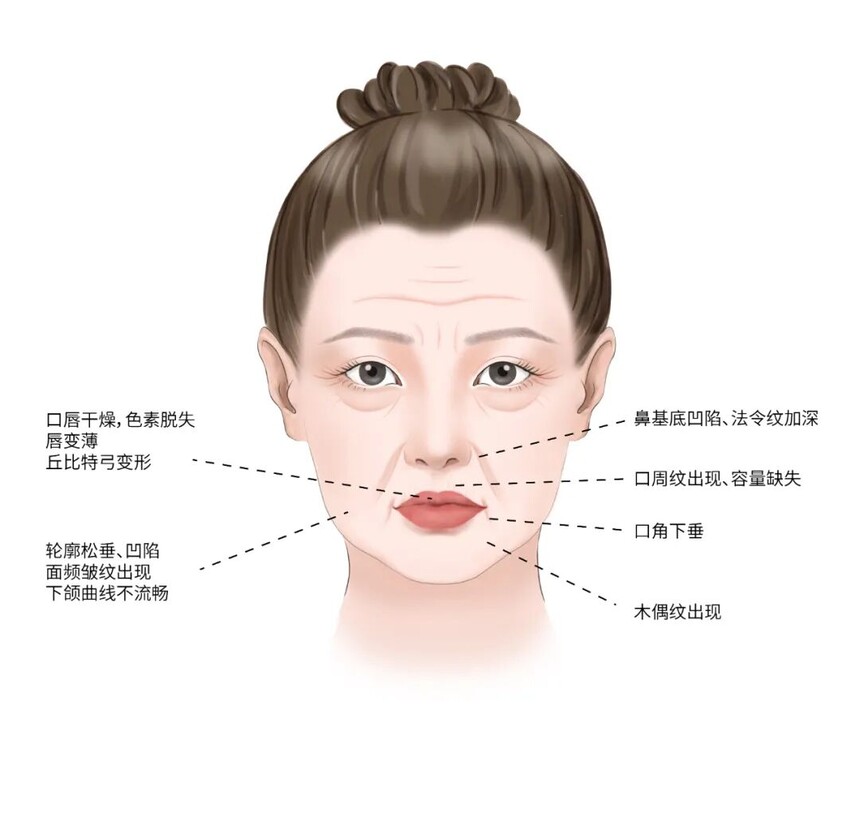 中面部松弛.jpg 中面部松弛.jpg