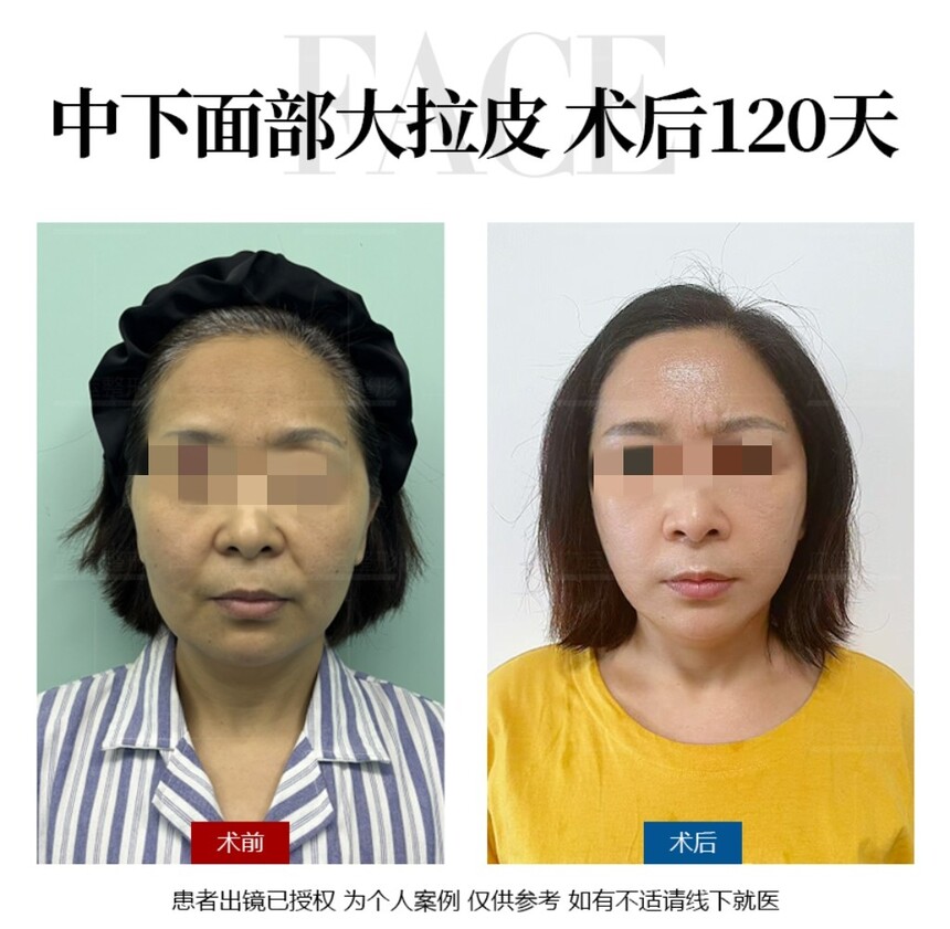 魏广运拉皮案例.jpg 魏广运拉皮案例.jpg