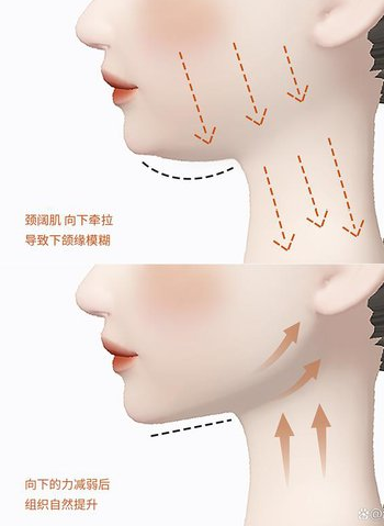 颈阔肌 颈阔肌