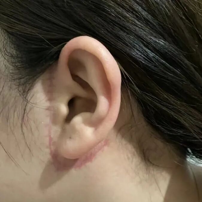 拉皮修复.jpg 拉皮修复.jpg