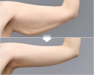 四肢拉皮 四肢拉皮