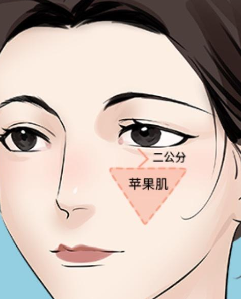 苹果肌复位 苹果肌复位