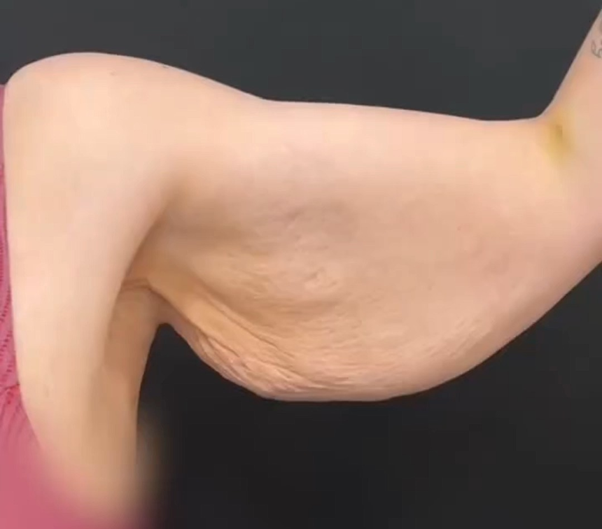 四肢拉皮 四肢拉皮