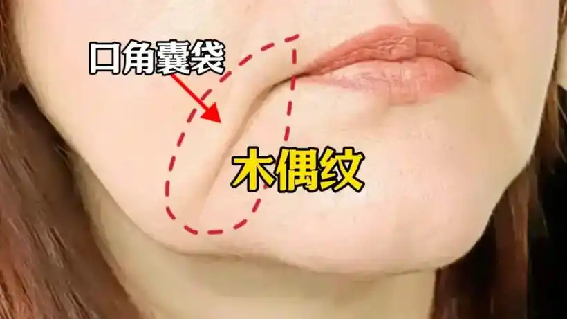 法令纹 法令纹