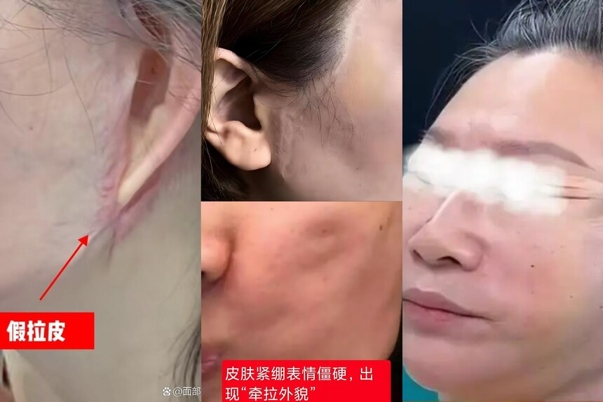 拉皮修复.jpg 拉皮修复.jpg