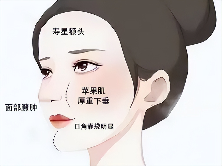 苹果肌馒化 苹果肌馒化