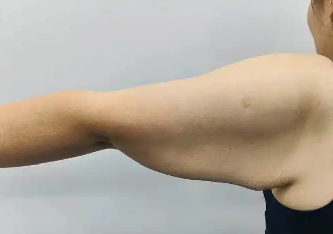 四肢拉皮 四肢拉皮