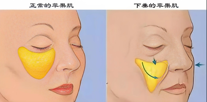 苹果肌复位 苹果肌复位
