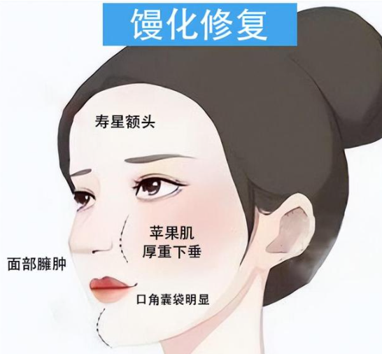 苹果肌馒化修复 苹果肌馒化修复