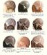 custom cranial prosthesis medical wigs