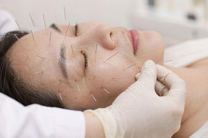 1790128217475733.jpg beauty-facial-acupuncture.jpg