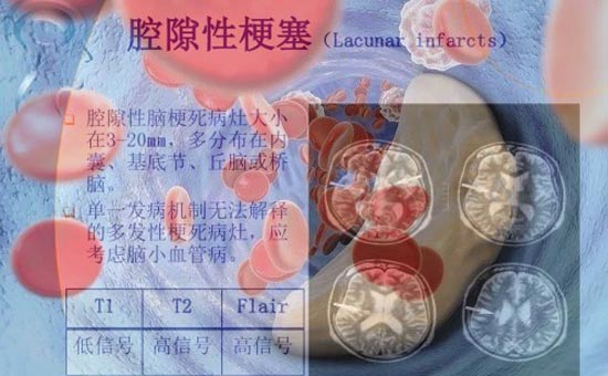 1腔梗-1.jpg